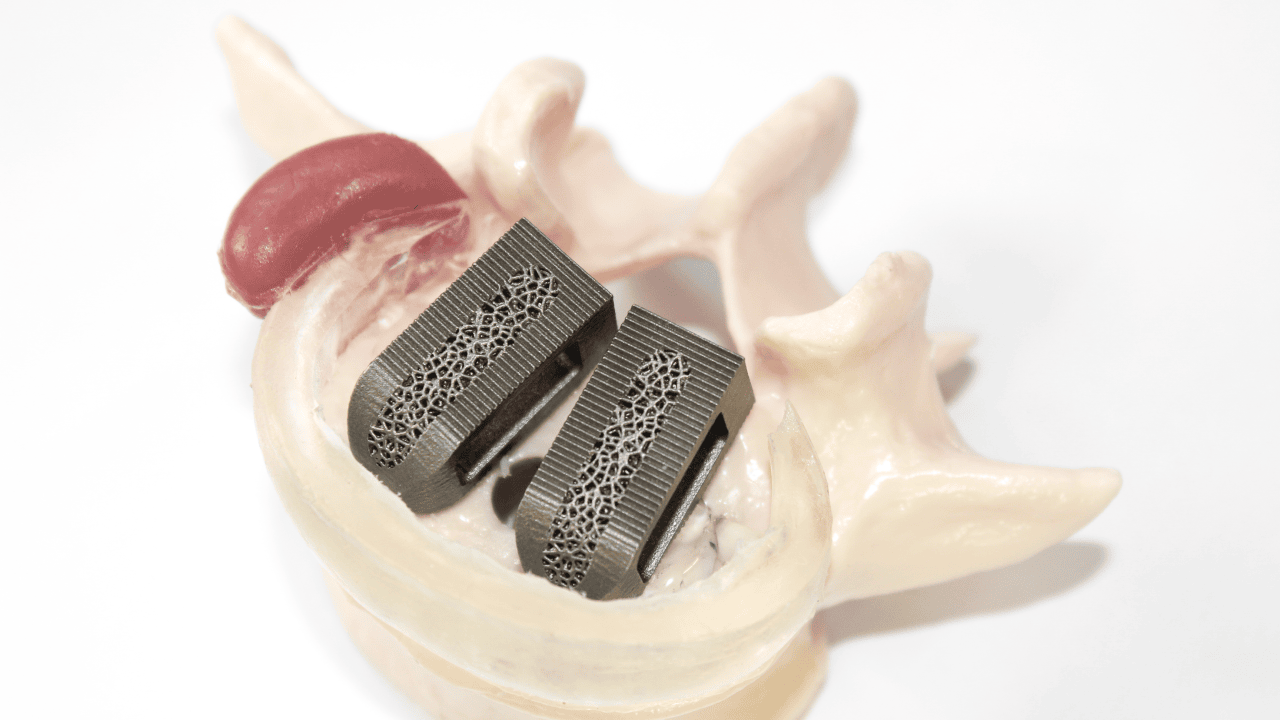 Medizinische Implantate aus amorphen Legierungen (Wirbelsäulen Cage)