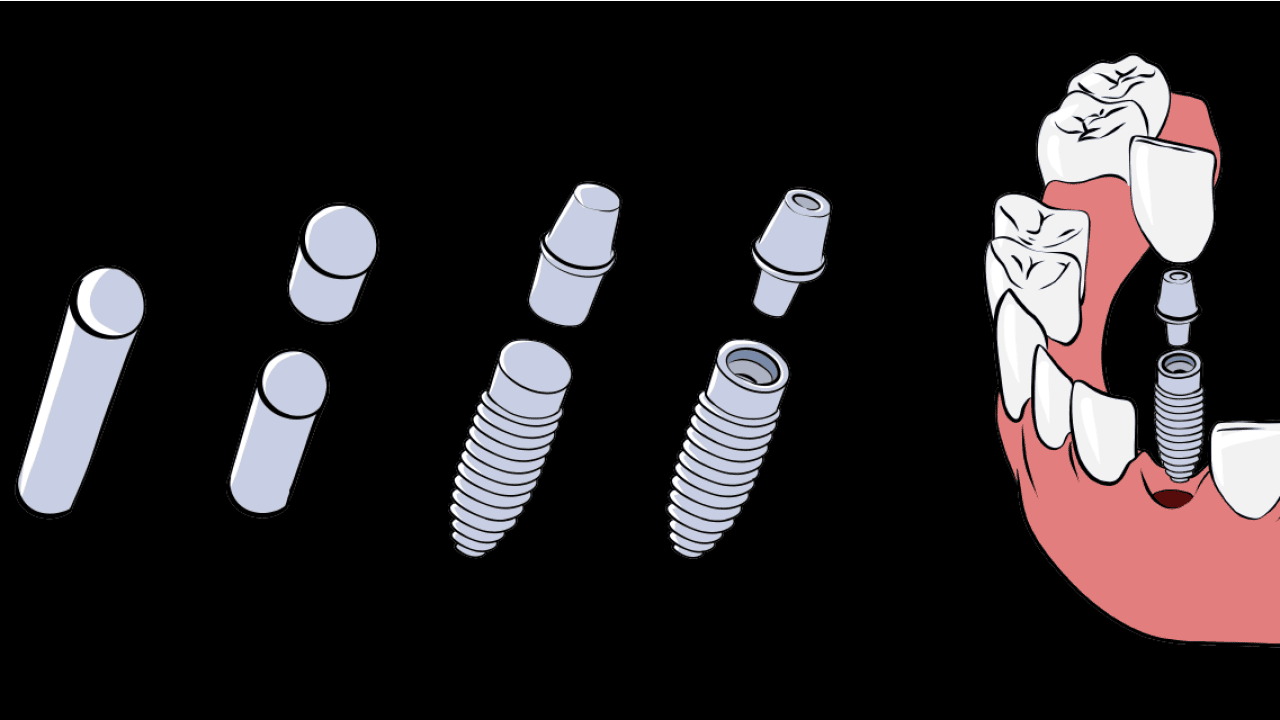 massgefertigte Titanstäbe für Dentalimplantate