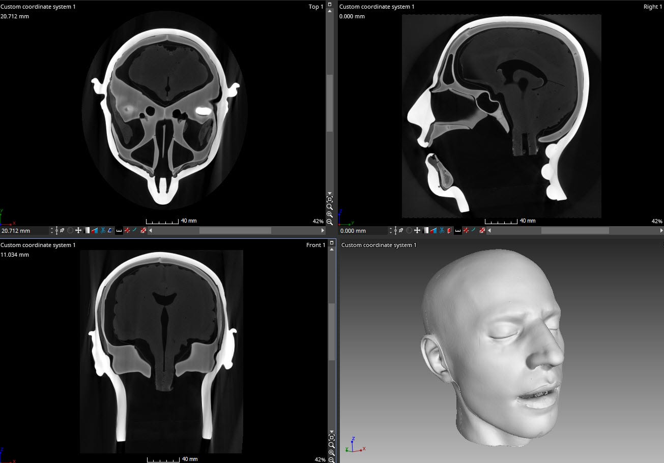 CT-Scan des Schädels